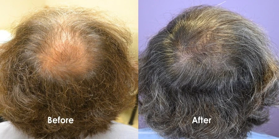 dutasteride beforeafter dutasteride beforeafter