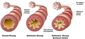 Asthma Asthma
